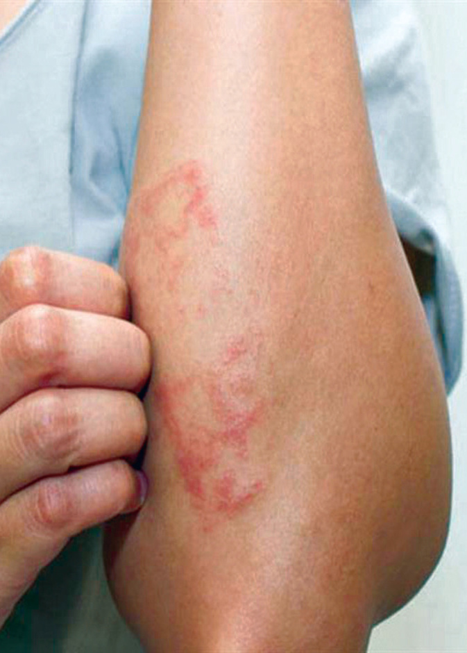  التقران السعفي يسبب بقع خشنة على الجلد