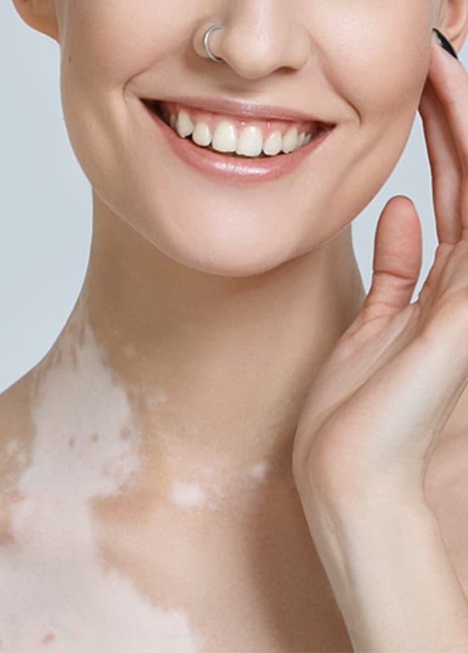 ماهي اعراض مرض البهاق الجلدي