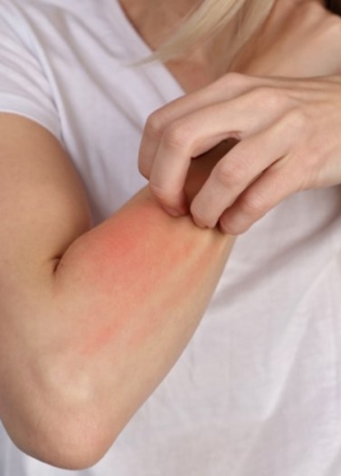 التسمم الشمسي يسبب التهيج و الألم