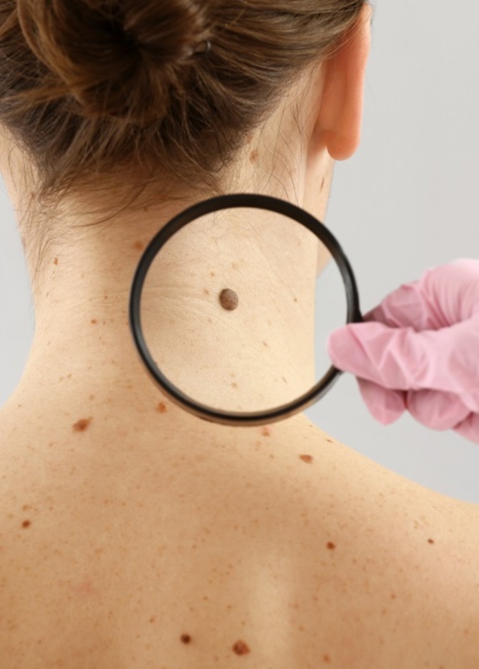 أهمية الفحص للكشف عن سرطان الجلد