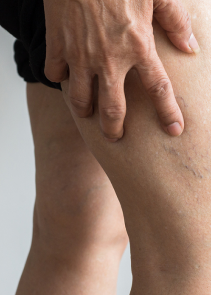 ماهو التخثر الوريدي العميق في الساق وما أسبابه