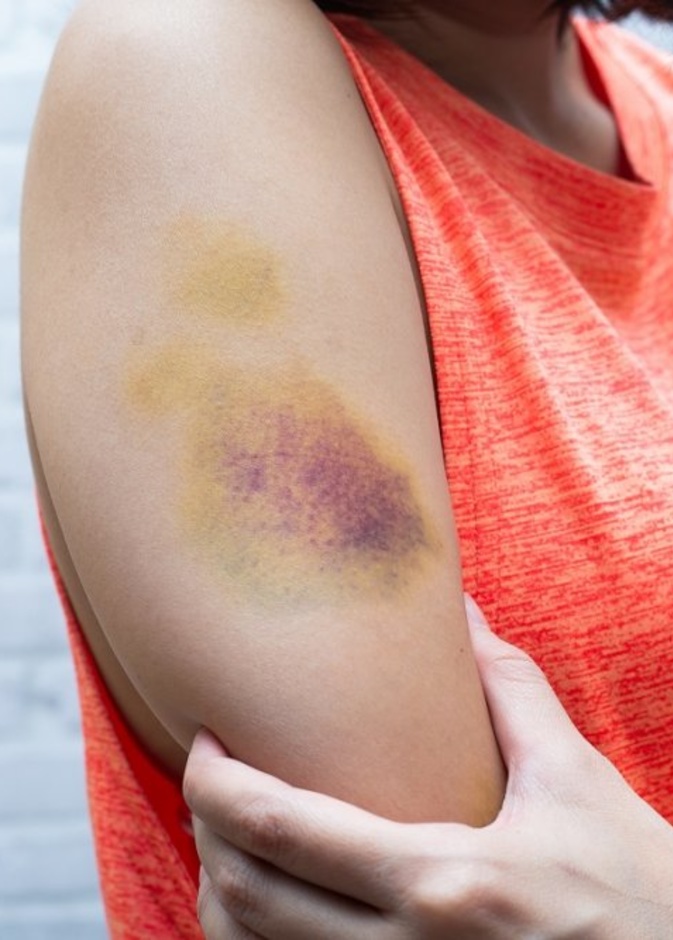  أسباب الكدمات على الجلد وطرق علاجها