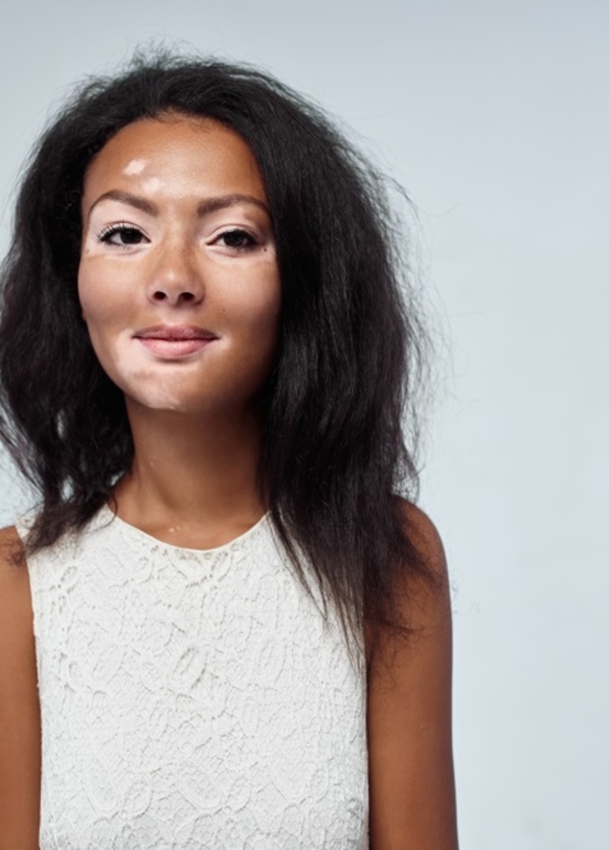 هل مرض البهاق معدي ام لا