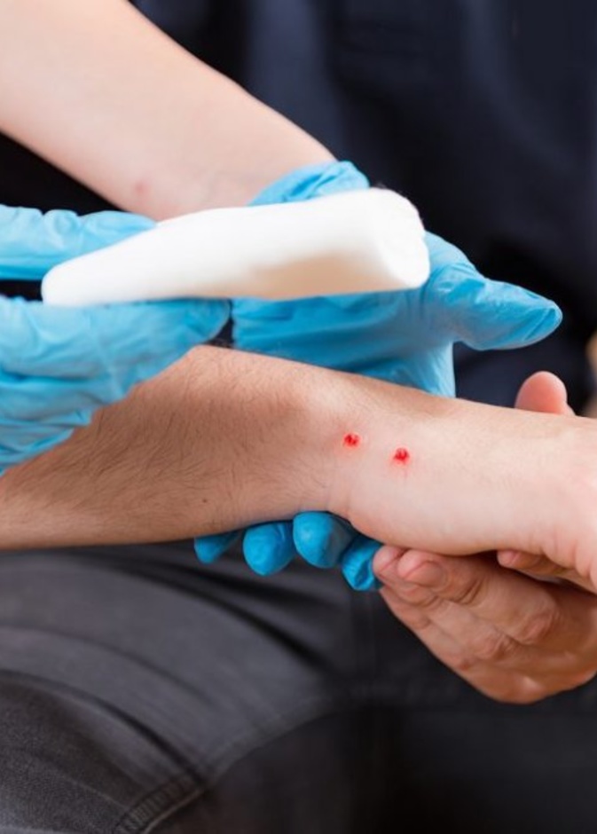 ماهي الاسعافات الاولية للدغة الافعى