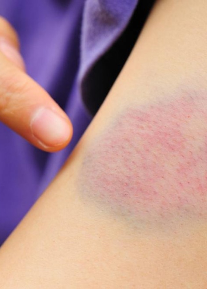 طرق الوقاية من الجلطة الدموية