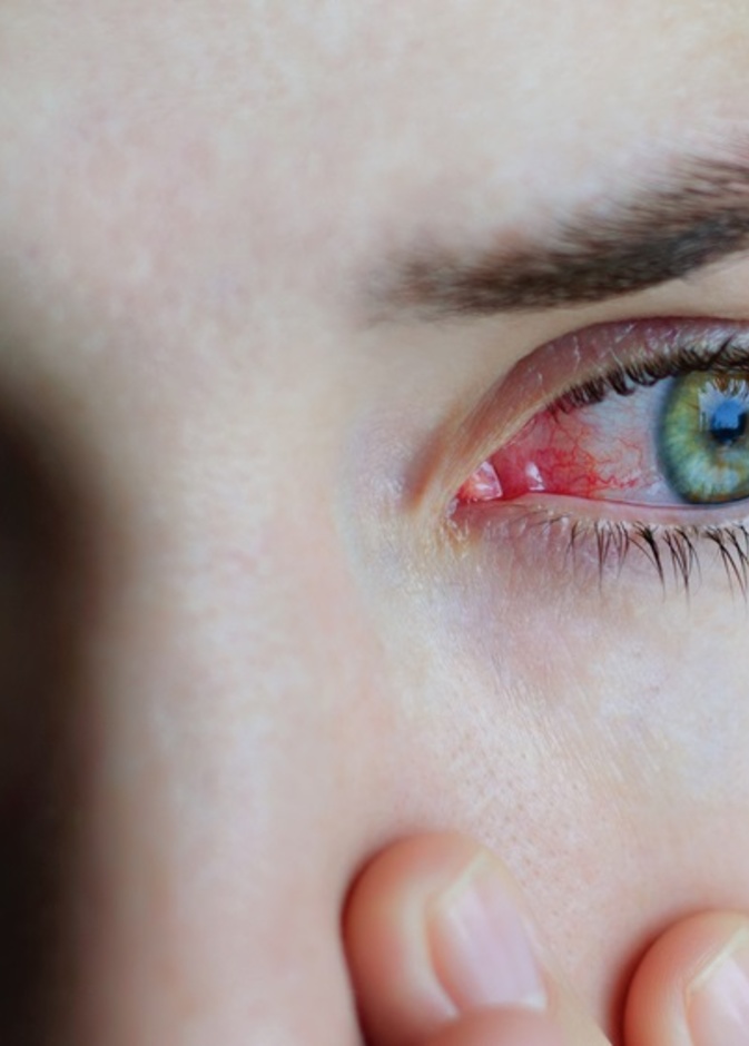 ما هو مرض التهاب ملتحمة العين وكيف ينتقل من خلاله عدوى فيروس كورونا