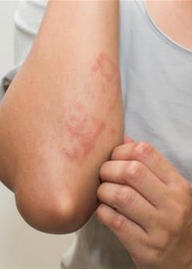 هل من الممكن ان يكون الطفح الجلدي من علامات الإصابة بفيروس كورونا