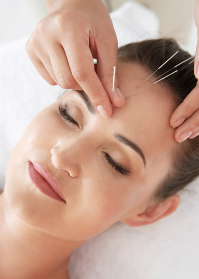 الإبر الصينية تساعد على تقليل التوتر