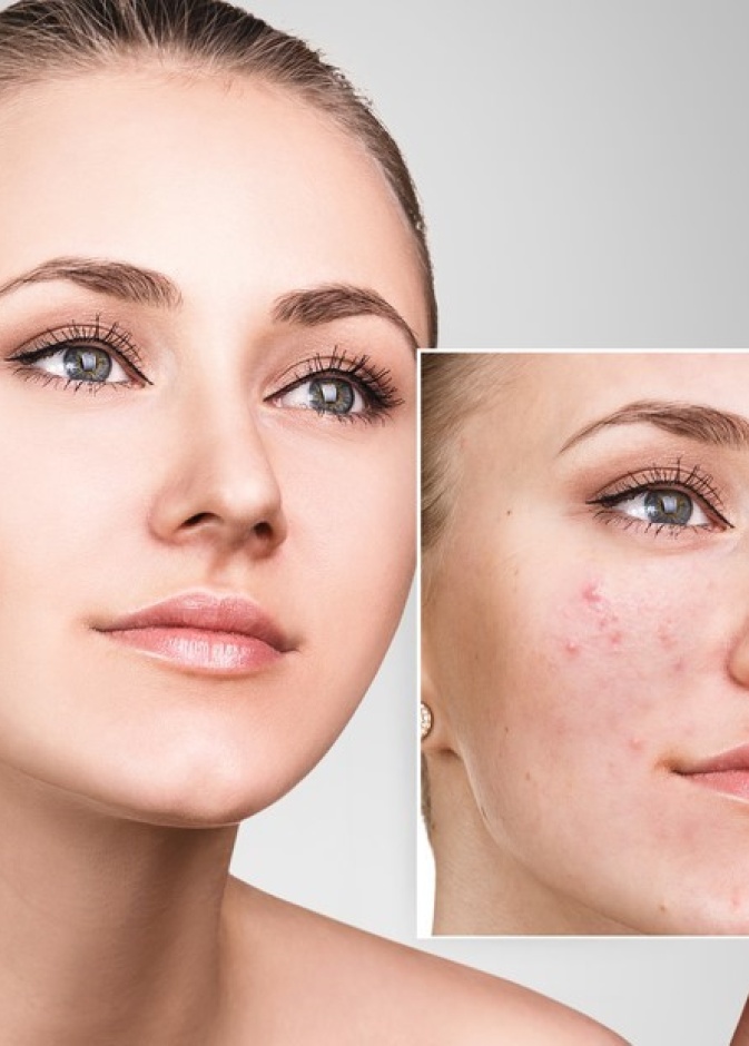 نصائح جمالية عند استخدام ماسك القرفة واللبن للتخلص من حب الشباب