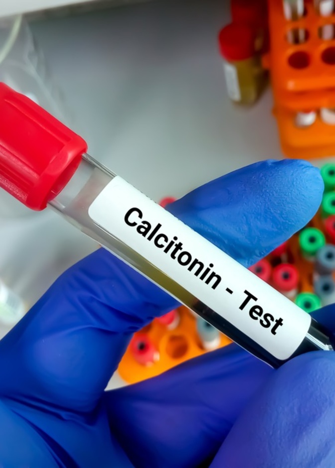  ما هو هرمون الكالسيتونين وما هي الاسباب المرضية وراء الزيادة في افرازه