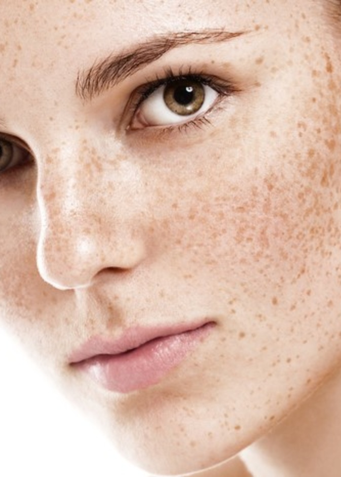  نصائح جمالية لعلاج النمش في الوجه