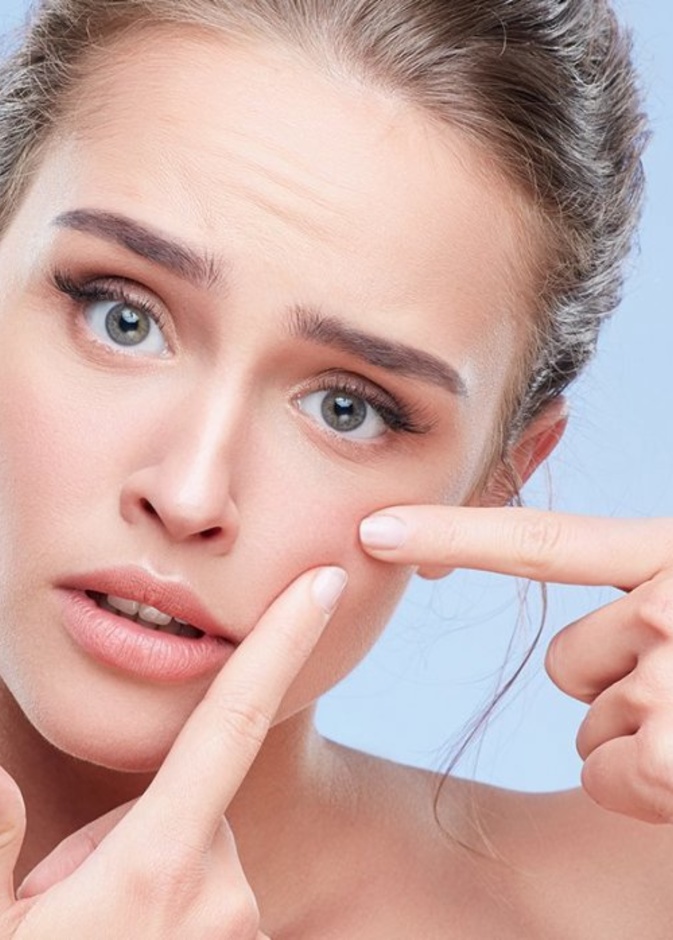 البثور مشكلة لا بد من حلها بسرعة قبل الزفاف