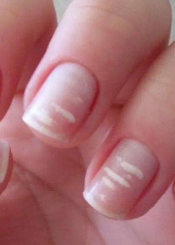 الخطوط البيضاء على الاظافر من اعراض كورونا
