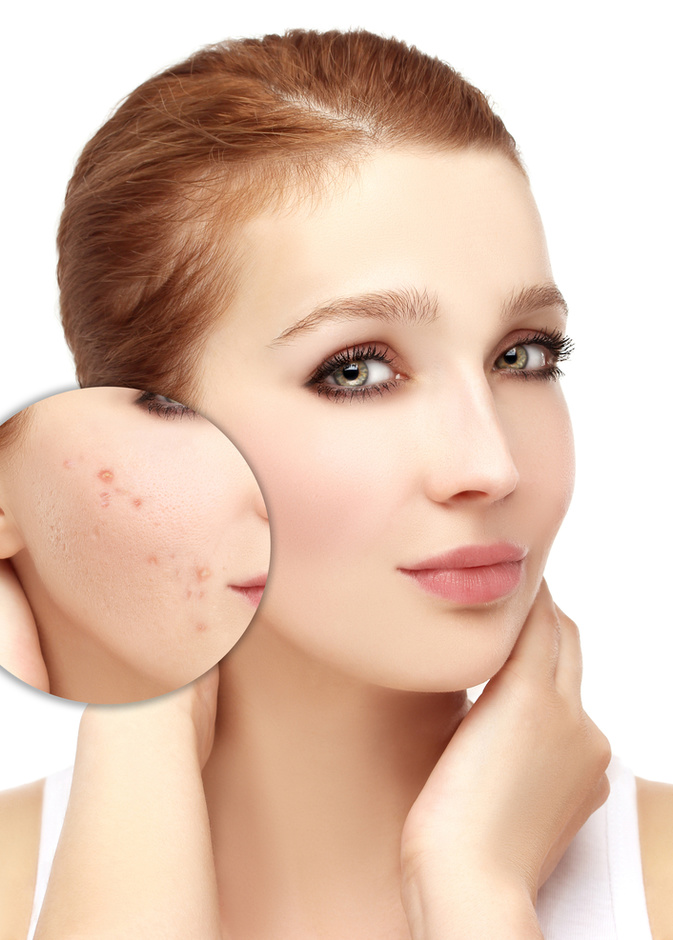  طرق علاج حب الشباب في المنزل