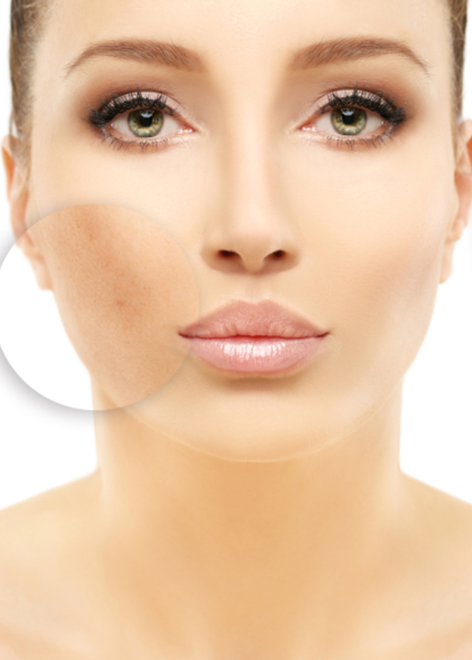  اضرار علاج التصبغات الجلدية بالليزر