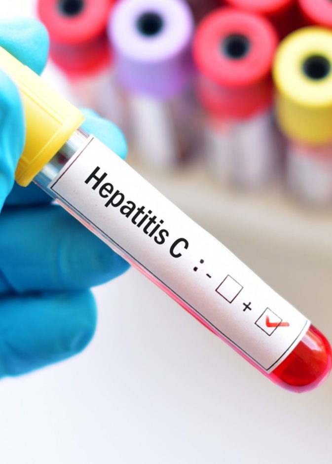 كيفية تشخيص التهاب الكبد الفيروسي وطرق علاجه