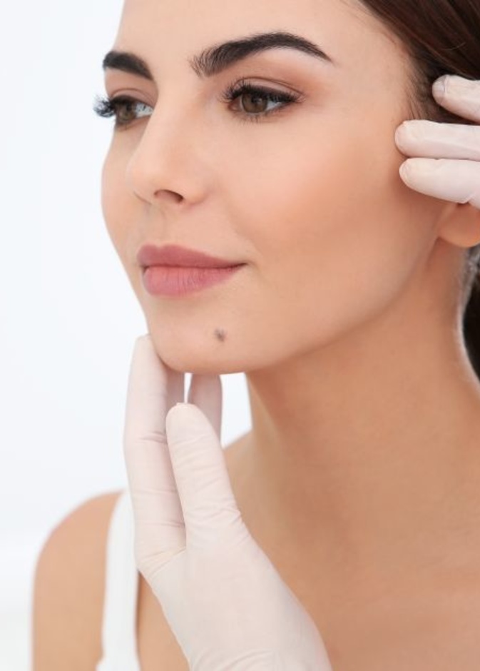 إزالة الشامات بالليزر تعد الطريقة الأسهل والأكثر استخداماً بين النساء