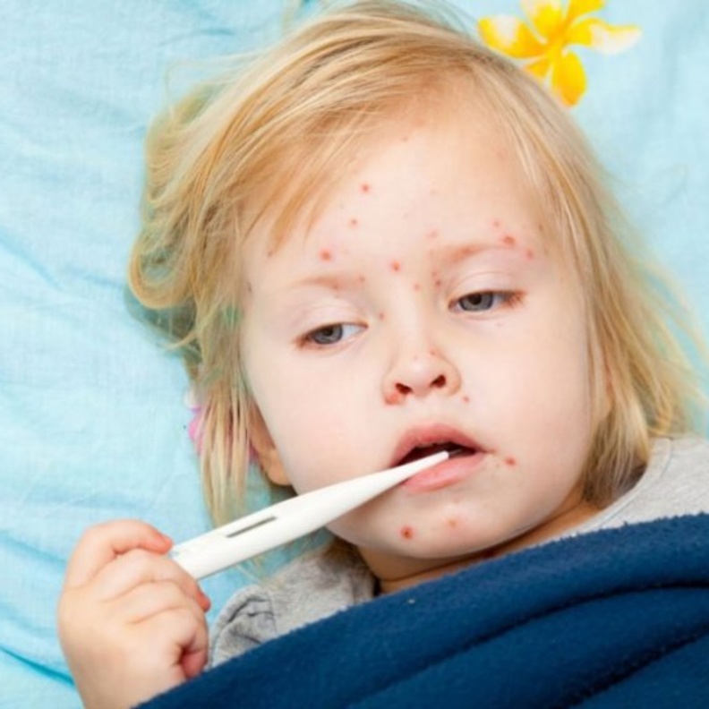 يجب ابعاد الطفل المصاب عن الآخرين لتجنب العدوى