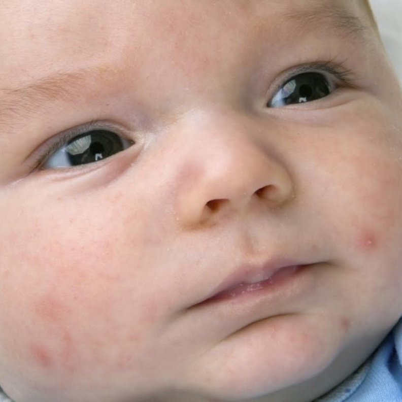 حمو النيل عند الرضع في فصل الصيف اسبابة وطرق علاجه