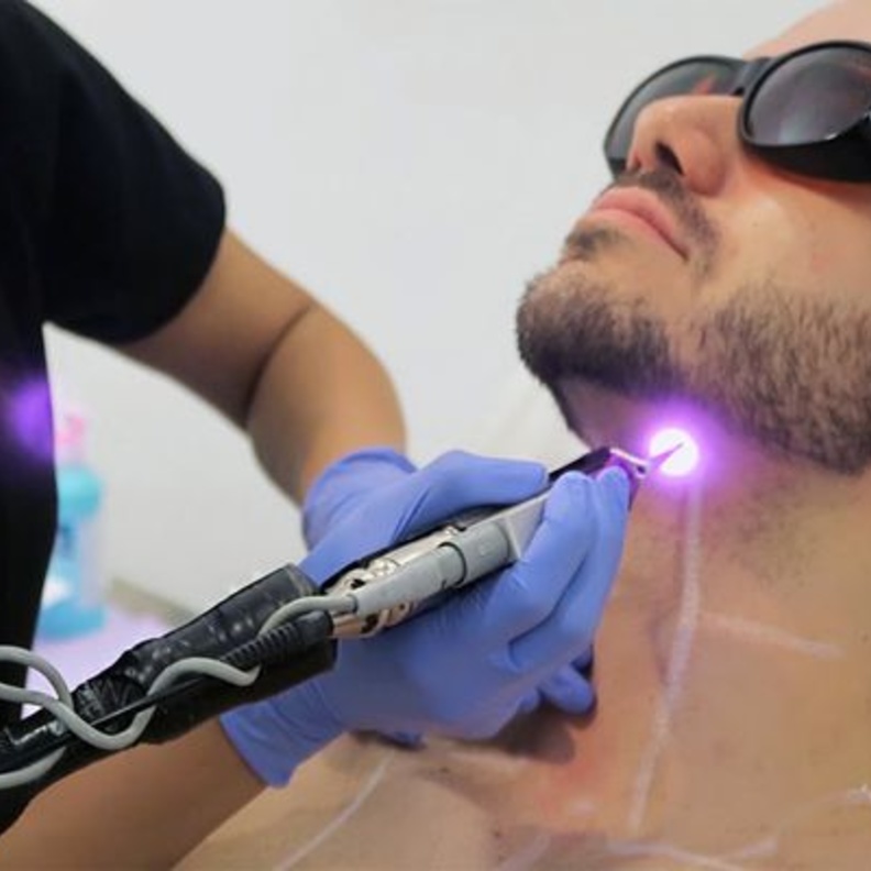 تحديد من الذقن بالليزر من عمليات التجميل المفضلة لدى الرجال