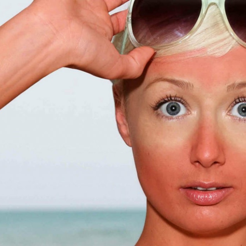 معالجة حروق الشمس بصودا الخبز