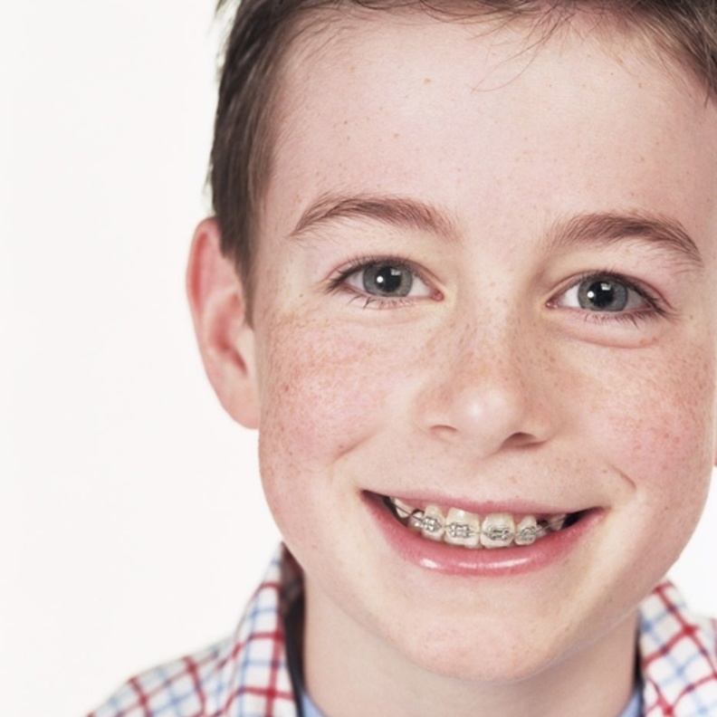 انواع تقويم الاسنان