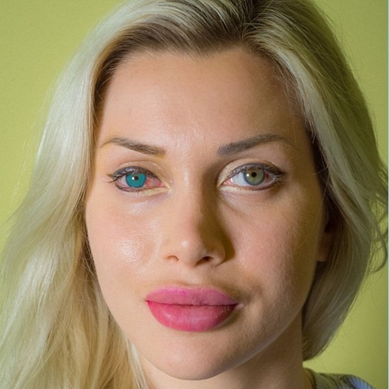 بيكسي فوكس اجرت جراحة لتغيير لون العيون