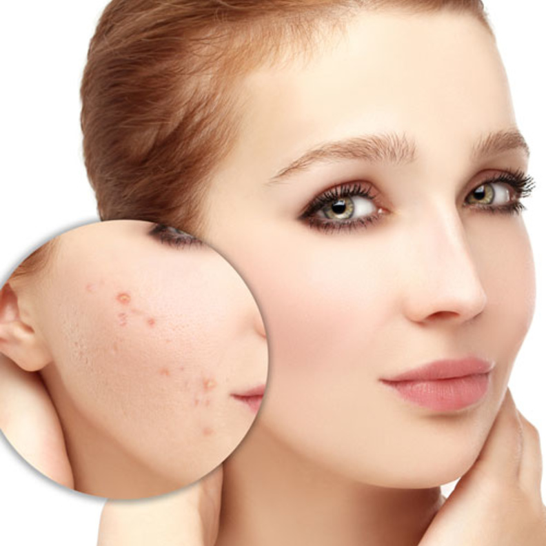 أهم الوصايا للتخفيف من حب الشباب