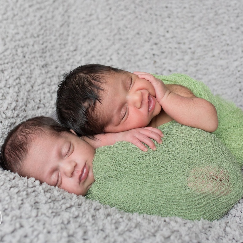 توأم سيامي بعد عملية فصلهما