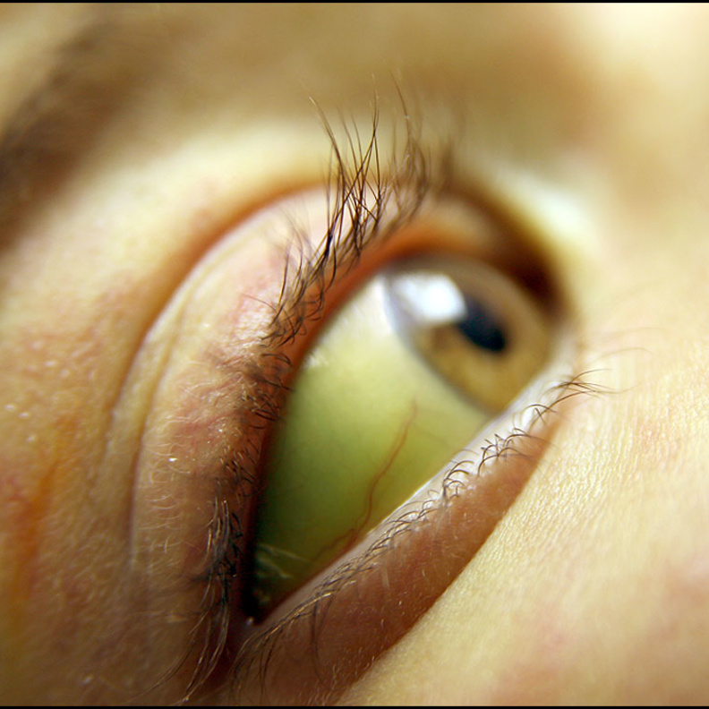  اليرقان أحد الأمراض التي تسبب إصفرار العين