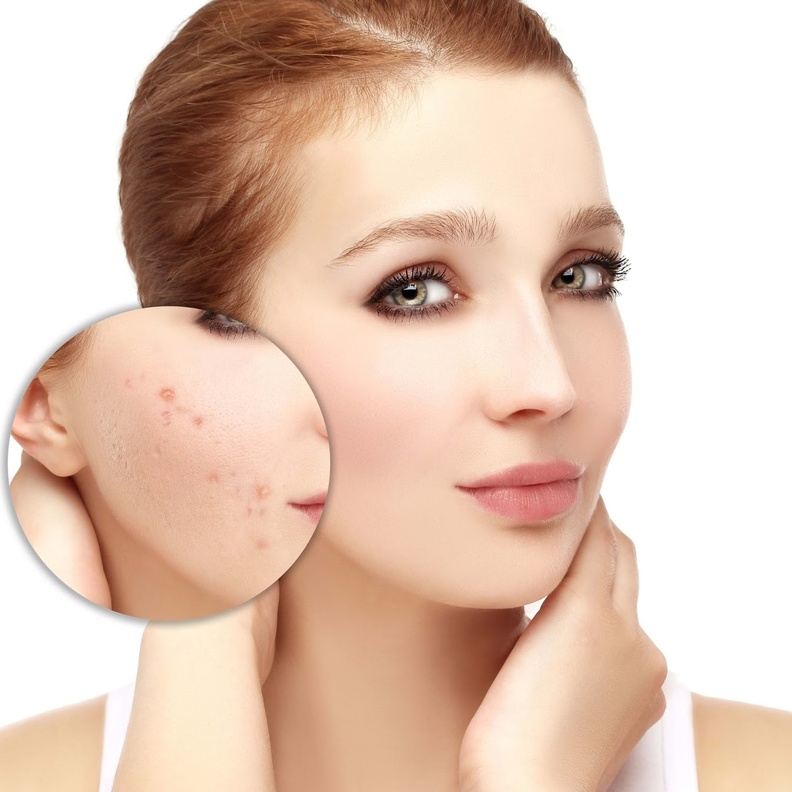 حب الشباب هو أكثر الامراض الجلدية شيوعا لدى الشباب