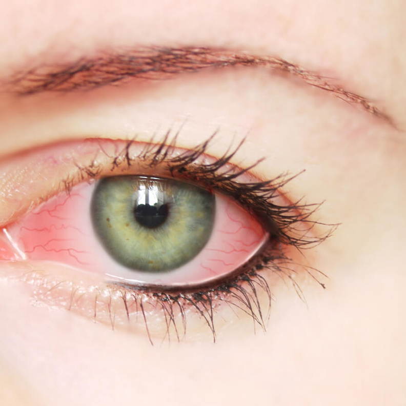 لتهابات العيون احد الامراض التي تنتقل من القطط للانسان