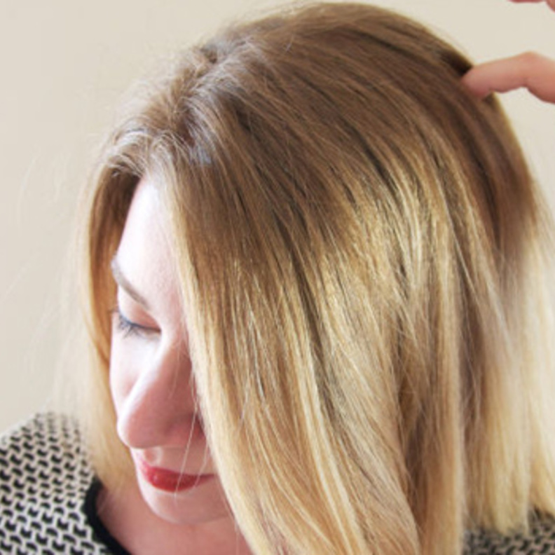 قشرة الشعر و الحكة من أعراض الإصابة بالصدفية