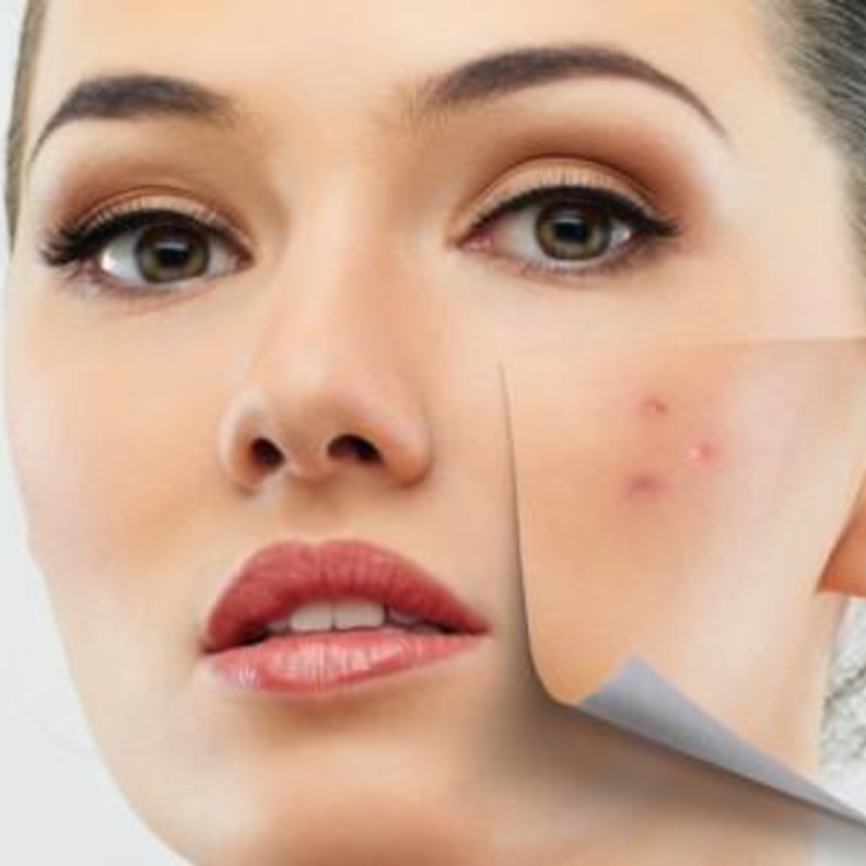 علاج حب الشباب للبشرة الدهنية 