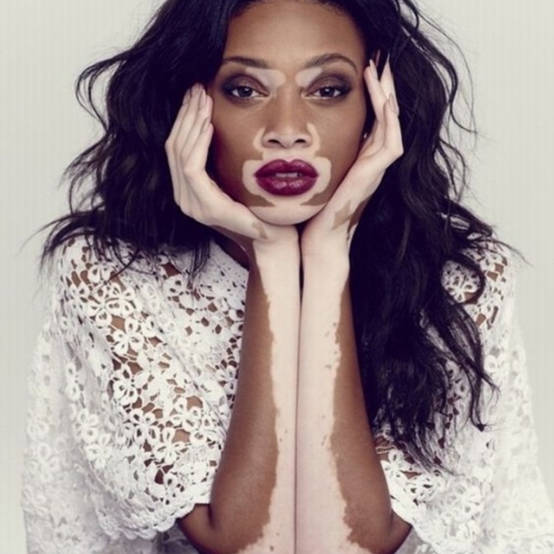 عارضة أزياء بمرض نادر تدخل قائمة النجمات الأكثر أناقة!