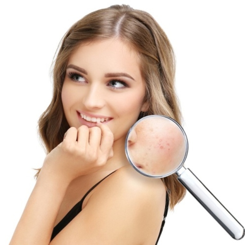 الثوم يعالج حب الشباب