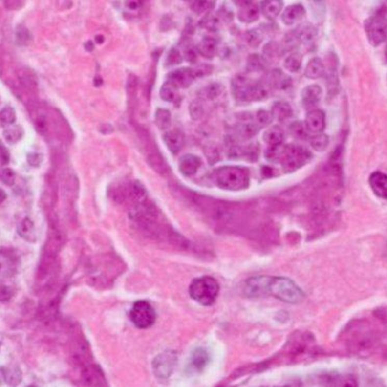 لسلامتكم .. إحذروا دودة السرطان!