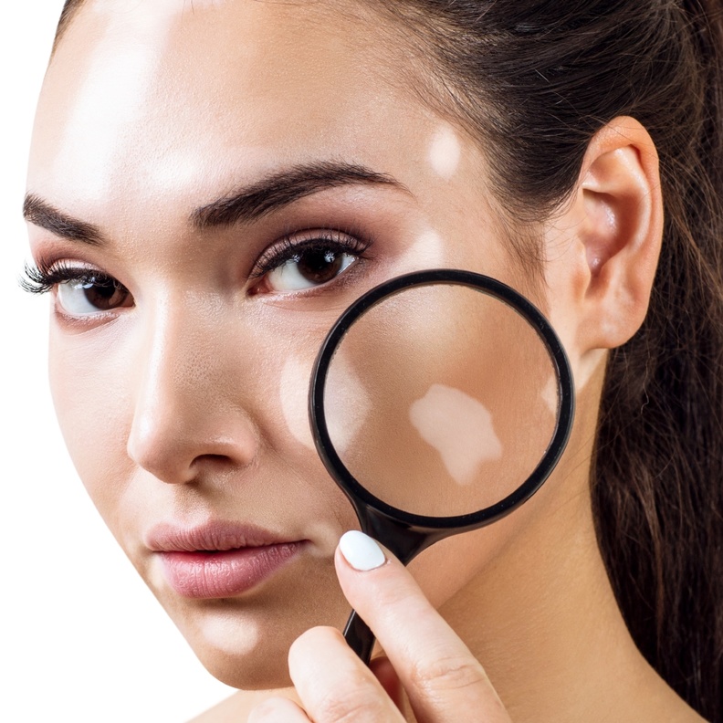 طرق طبيعية لعلاج البهاق في الوجه نهائياً