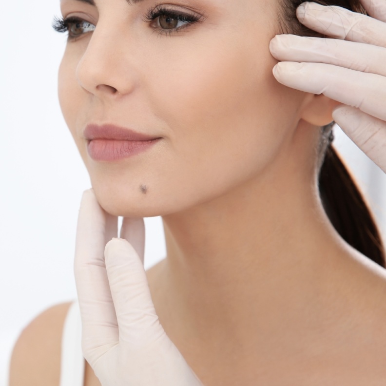  كيف تتم إزالة الشامة من الوجه وأفضل الطرق