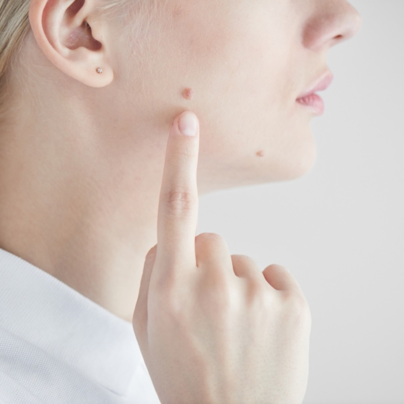 خل التفاح يساعد على التخلص من الشامات بشكل سريع