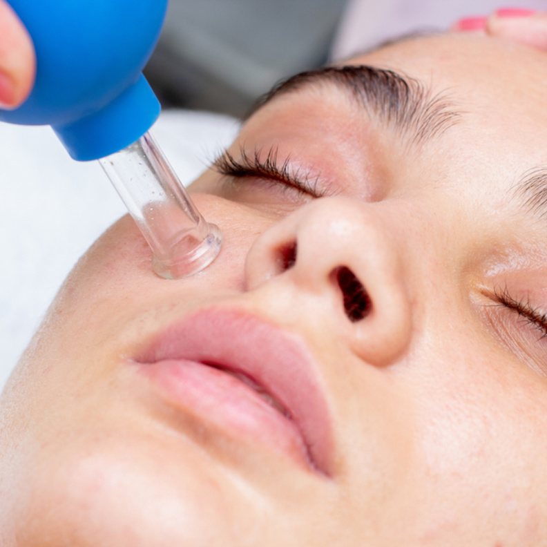 طريقة عمل الحجامة للوجه وأهم النصائح عند تطبيقها