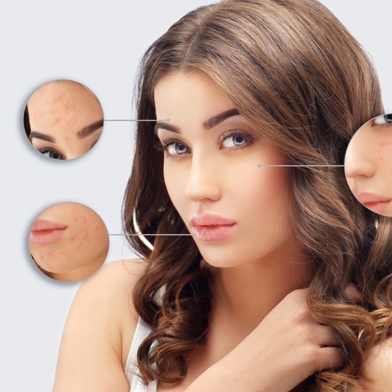  أفضل الطرق لعلاج ندبات حب الشباب نهائياً