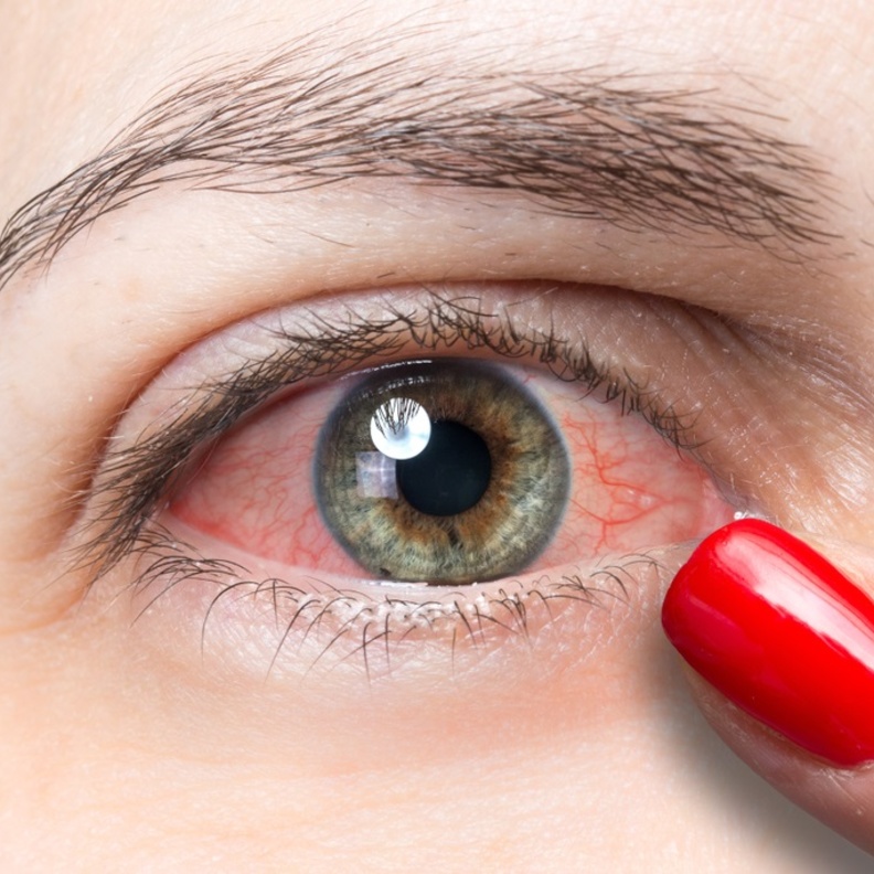 هل إحمرار العينين يعد دليلاً على الإصابة بمتحور أوميكرون