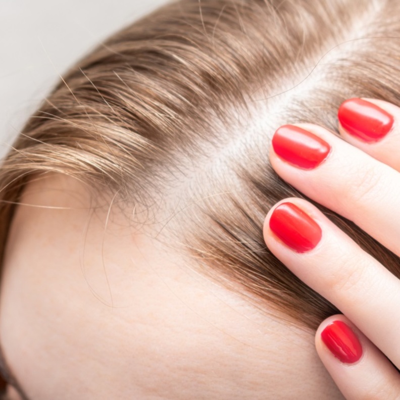 مرض الثعلبة ناجم عن عدوى فطرية تصيب فروة الرأس