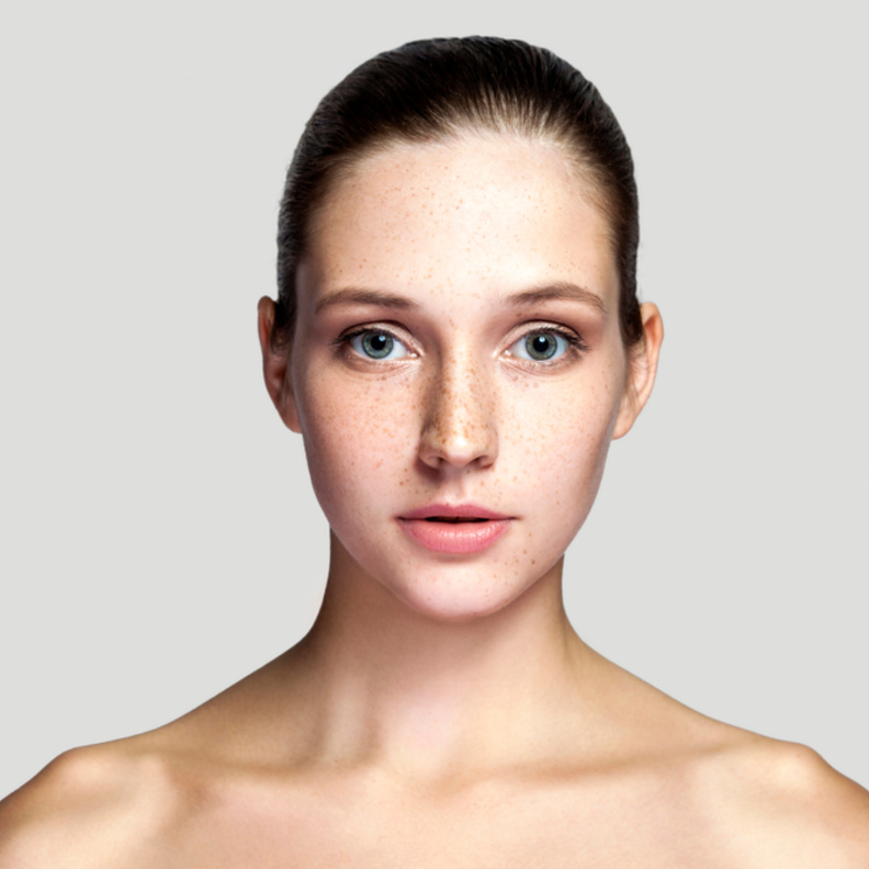 طرق إزالة النمش من الوجه تجميلياً وما هي نتائجه