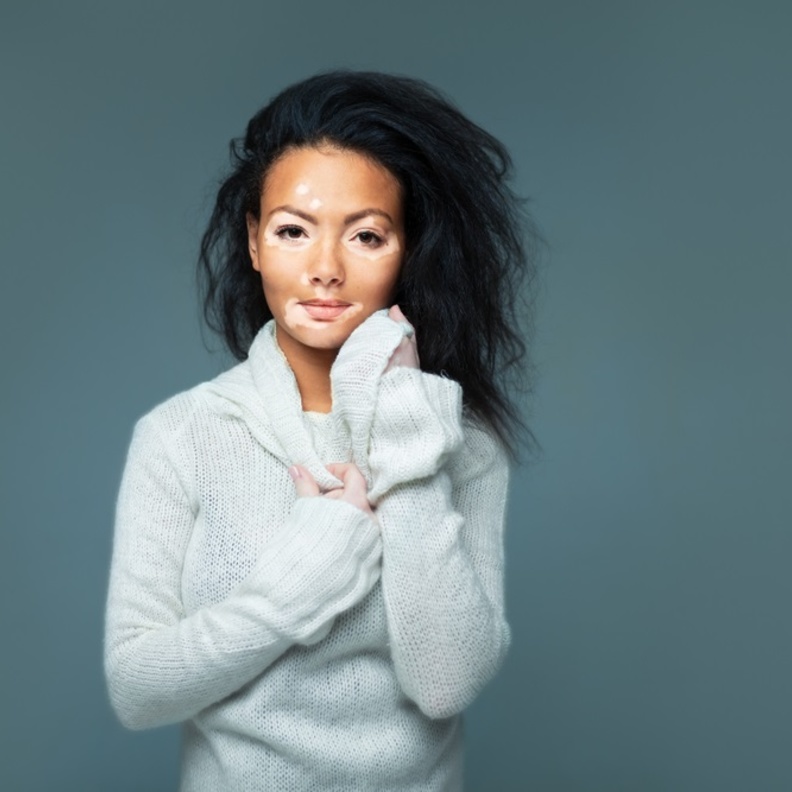 البهاق مرض يصيب الجلد ويتسبب بظهور بقع بيضاء