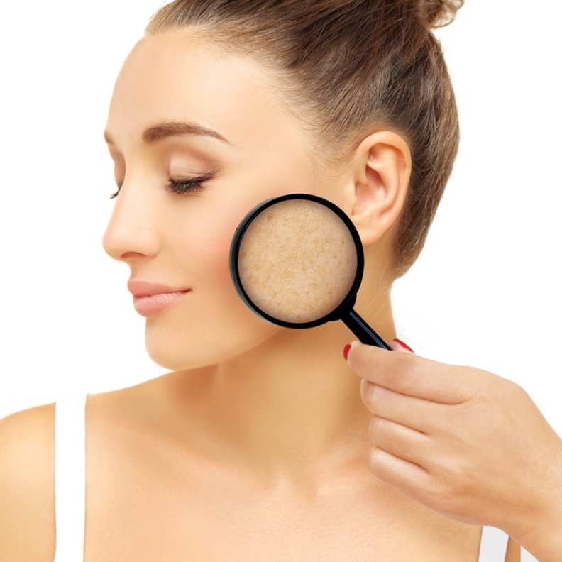 تصبغات الجلد مشكلة يمكن علاجها بالادوية والليزر