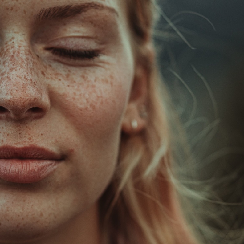 كيف يتم علاج النمش تجميلياً