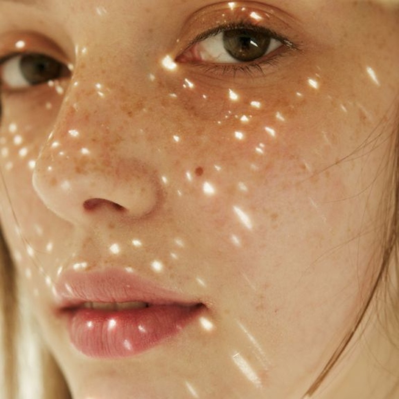 إزالة النمش والكلف في الصيف بالطرق الطبيعية وطريقة استخدامها