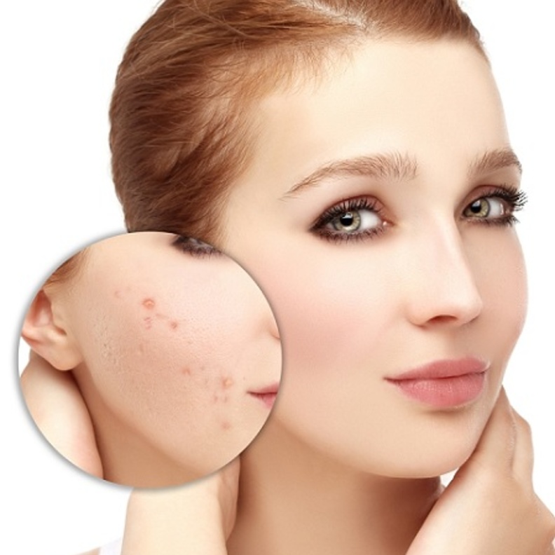 علاج حب الشباب بالوصفات